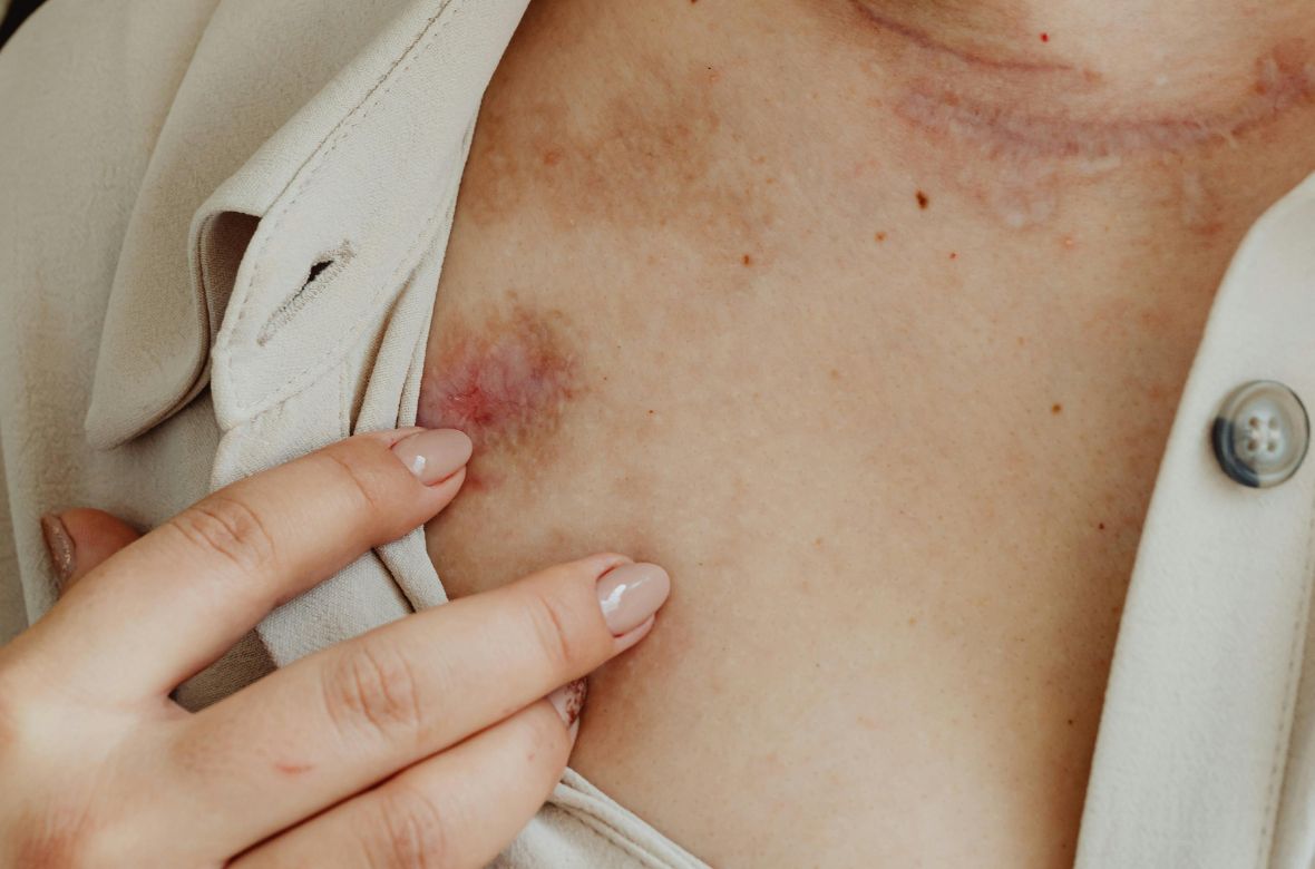 Cicatrice chéloïde : symptômes, traitement et prévention